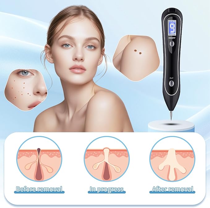 Skin Clinic Freeze Point for Warts and Skin Tags, GJW-02